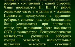 Синдром Титце. Симптомы, причины и лечение