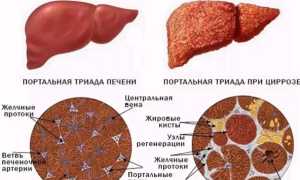 Билиарный цирроз печени. Что это такое, симптомы, лечение