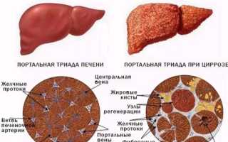 Билиарный цирроз печени. Что это такое, симптомы, лечение