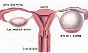 Киста яичника. Можно ли лечить без операции