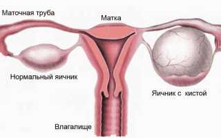 Киста яичника. Можно ли лечить без операции