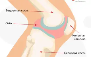 Мениск коленной чашечки. Лечение повреждения сустава, народные средства, мази, таблетки