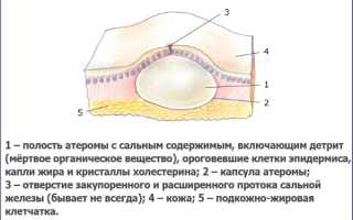 Шишка под кожей на руке, шее, лице, спине. Фото высыпания в виде бугорков. Причины и лечение