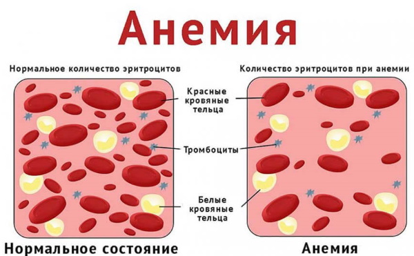 Синдром мальабсорбции. Что это у детей, взрослых, симптомы, рекомендации, лечение