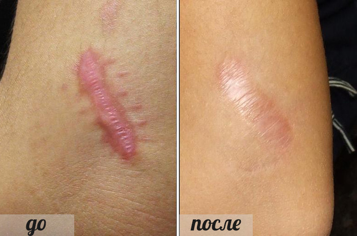 Бадяга порошок. Инструкция по применению от синяков под глазами, пигментных пятен на лице, прыщей