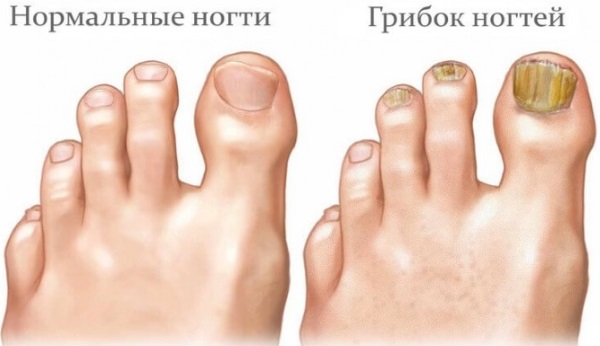 Белые точки на ногтях у ребенка, взрослого. Причины, как лечить