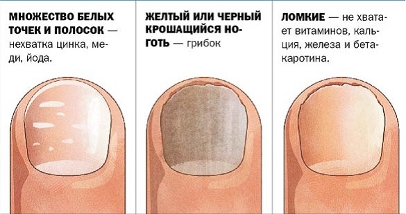 Белые точки на ногтях у ребенка, взрослого. Причины, как лечить