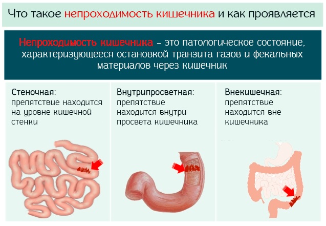Спринцовка для новорожденных. Размер, как пользоваться для клизмы, носа, от газиков, цены