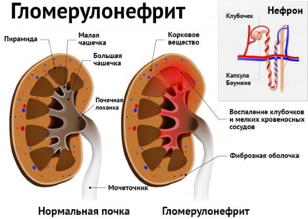 Болит почка с левой стороны. Что это может быть, причины, симптомы и лечение