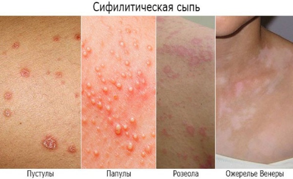 Болезни, передающиеся через поцелуй, слюну. Список