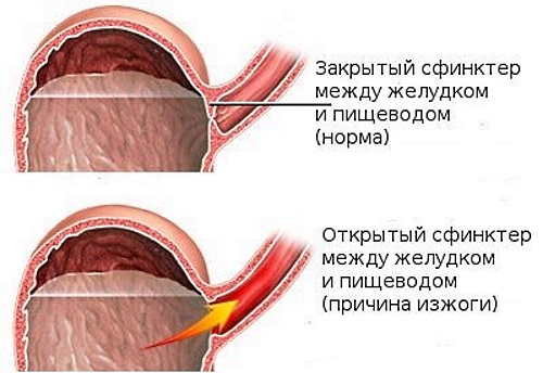 Что помогает от изжоги: медикаментозное лечение, народные средства и методы в домашних условиях