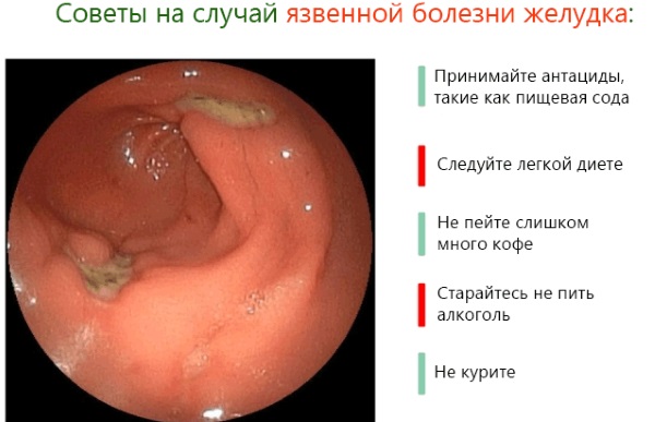 Что помогает от изжоги: медикаментозное лечение, народные средства и методы в домашних условиях