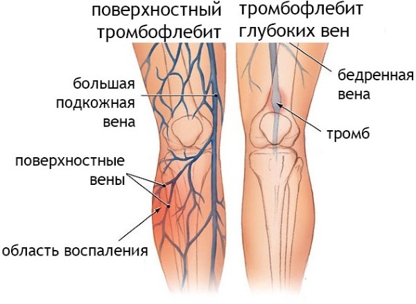 Раствор глюкозы 5-процентный. Инструкция по применению, цена