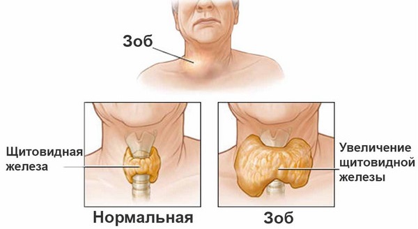 Эутирокс. Отзывы, побочные эффекты, передозировка. Как принимать таблетки для похудения, при беременности, гипотиреозе