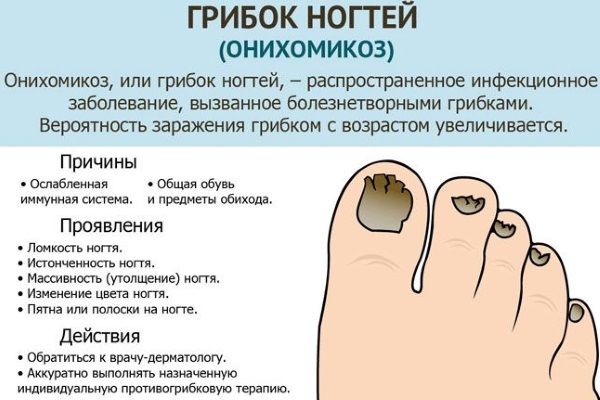Фундизол от грибка ногтей. Инструкция по применению, цена, аналоги, отзывы