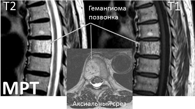 Гемангиома в теле позвонка l1-l2-l3-l4, th7-th10-th12. Что это такое