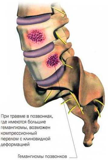 Гемангиома в теле позвонка l1-l2-l3-l4, th7-th10-th12. Что это такое