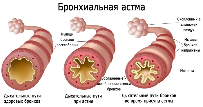 Гипокситерапия - лечение горным воздухом. Показания, противопоказания, аппараты