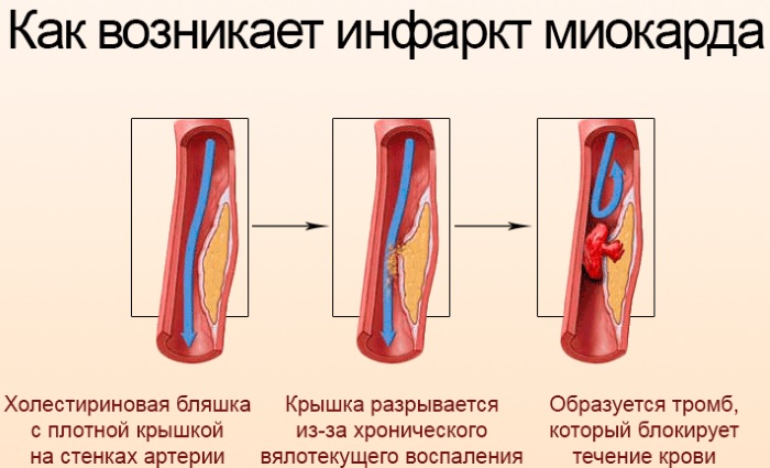 Гипокситерапия - лечение горным воздухом. Показания, противопоказания, аппараты