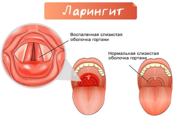 Пектусин таблетки для рассасывания. Инструкция по применению, цена, отзывы
