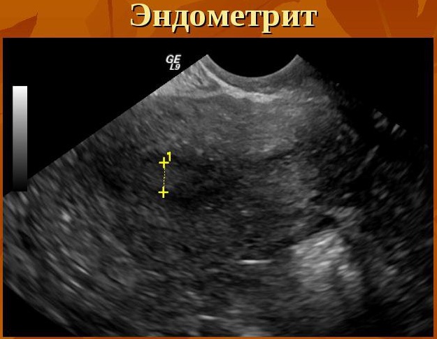 Хронический метроэндометрит. Что это такое, как лечить, причины, клинические рекомендации