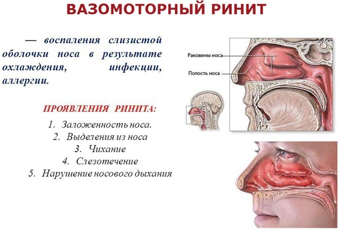 Називин (Nasivin) для детей. Инструкция по применению: спрей, капли. Цена, отзывы