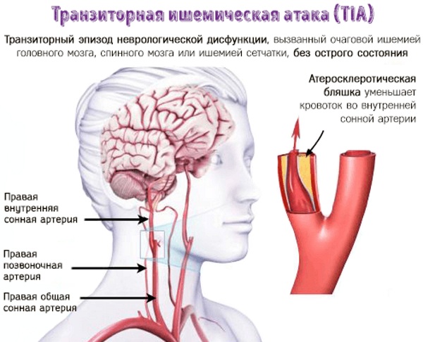 Транзиторная ишемическая атака. Что это такое, причины, симптомы, лечение