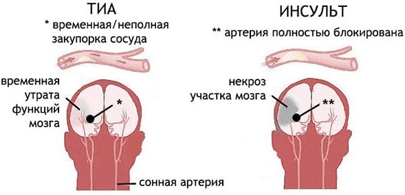 Транзиторная ишемическая атака. Что это такое, причины, симптомы, лечение