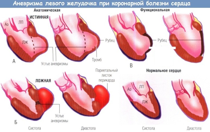 Транзиторная ишемическая атака. Что это такое, причины, симптомы, лечение
