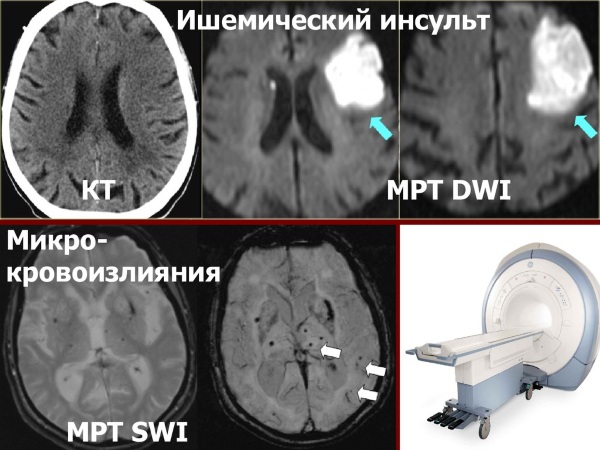 Транзиторная ишемическая атака. Что это такое, причины, симптомы, лечение