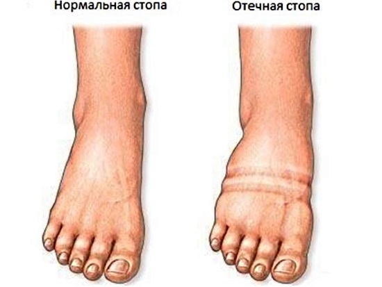 Как избавиться от отечности лица под глазами, тела, ног. Лекарства, народные средства
