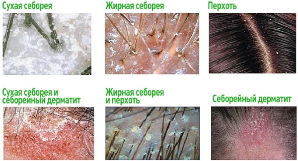 Низорал (Nizoral) шампунь. Инструкция по применению, цена, отзывы, аналоги