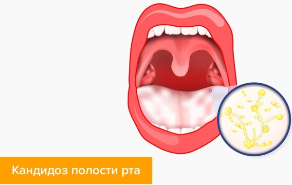 Кандид (Candid) раствор для полости рта. Цена, инструкция, аналоги для детей, взрослых