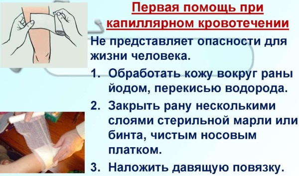 Капиллярное кровотечение. Как остановить: способы, алгоритм, первая помощь. Отличия от венозного