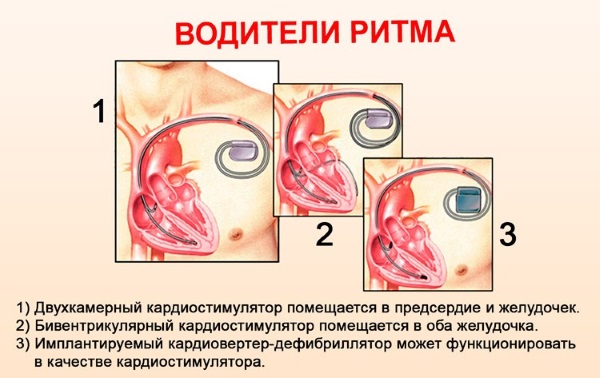 Кардиостимулятор. Что это такое, виды, как работает, сколько стоит, операция по установке, жизнь с ним