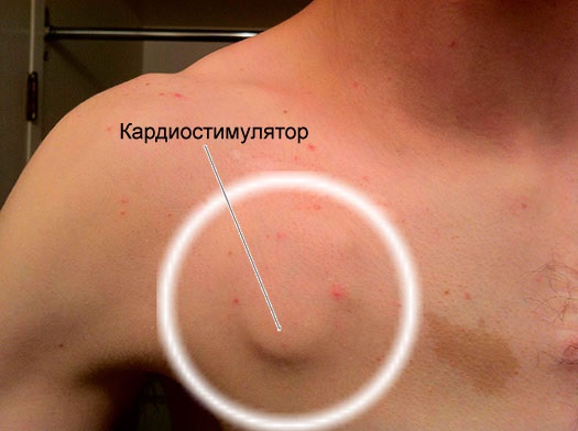 Кардиостимулятор. Что это такое, виды, как работает, сколько стоит, операция по установке, жизнь с ним