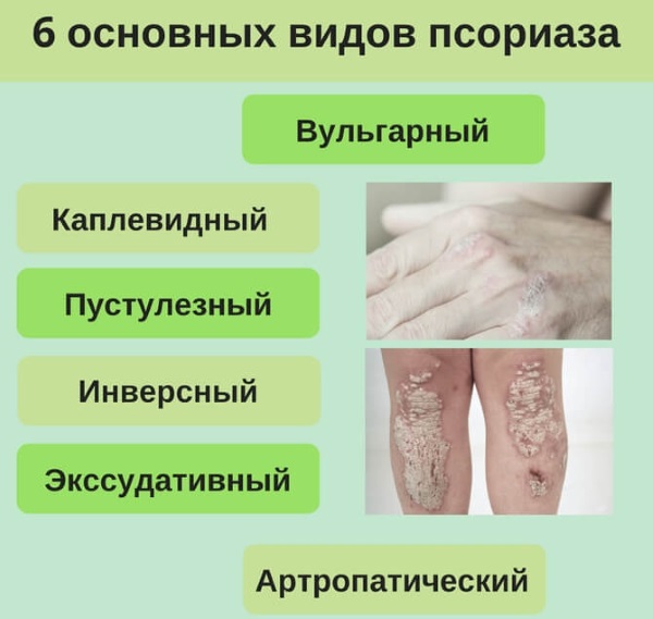 Китайские мази от псориаза негормональные, на Алиэкспресс. Фото, какие купить, применение