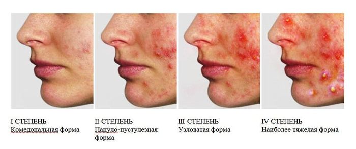 Как избавиться от комедонов на лице. Причины и лечение, мази, народные средства, питание