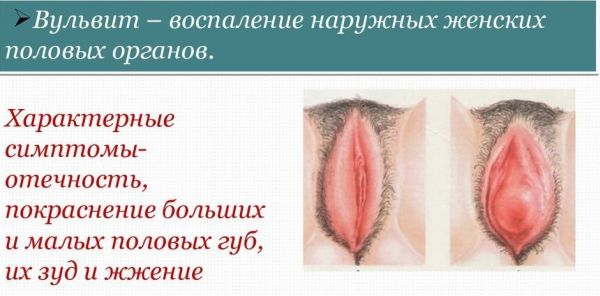 Зеленоватые выделения у женщин и зуд перед и после месячных, овуляции, при беременности, после родов