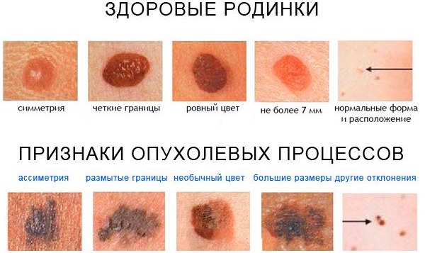 Удаление родинок лазером. Цена, отзывы