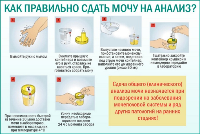 Уробилин в моче. Норма у женщин, мужчин по возрасту