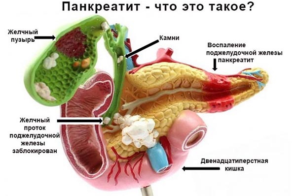 Лечение панкреатита у взрослых медикаментами, препараты для капельницы, травы, диета