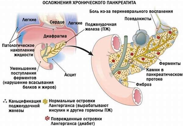Лечение панкреатита у взрослых медикаментами, препараты для капельницы, травы, диета