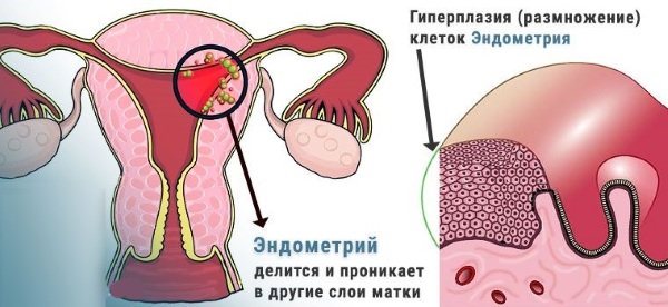 ГПЭ в гинекологии. Что это такое, симптомы, лечение гормонами, народными средствами, причины, последствия