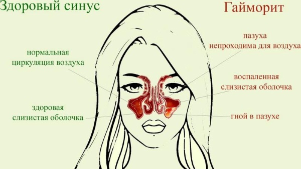 Мазь Симановского для носа. Инструкция по применению, отзывы