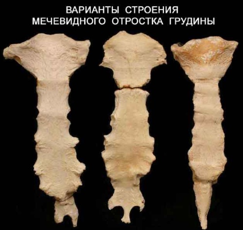 Мечевидный отросток грудины. Фото, где находится, болит при надавливании, увеличился, симптомы воспаления, лечение