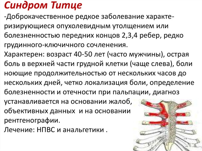 Мечевидный отросток грудины. Фото, где находится, болит при надавливании, увеличился, симптомы воспаления, лечение