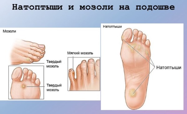 Компид (Compeed) пластырь от влажных мозолей, сухих, герпеса, натоптышей. Инструкция, виды, цена