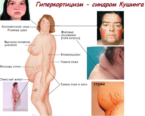 Будесонид-натив (Budesonid-nativ) для ингаляций. Цена, инструкция по применению, аналоги