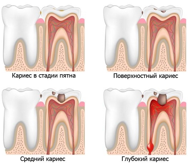 Недостаток фтора в организме у женщин, мужчин. Симптомы, что развивается, к чему приводит